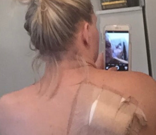 My Skin Cancer Journey